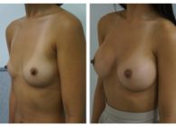 BA-Breast_Augmentation-02