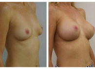 BA-Breast_Augmentation-06